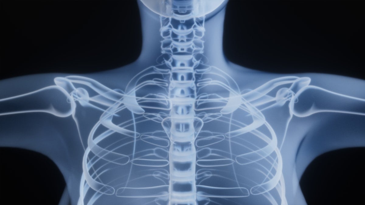 Radiographie épaule détruite