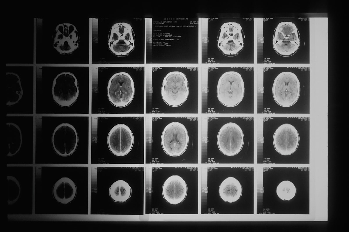 Des médecins ont cru à un cancer du cerveau… c'était des vers.